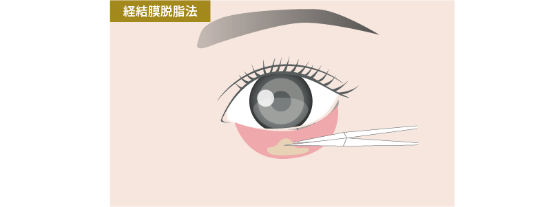 経結膜脱脂術